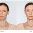 Botox and botox Alternatives for frown lines and skin wrinkles
