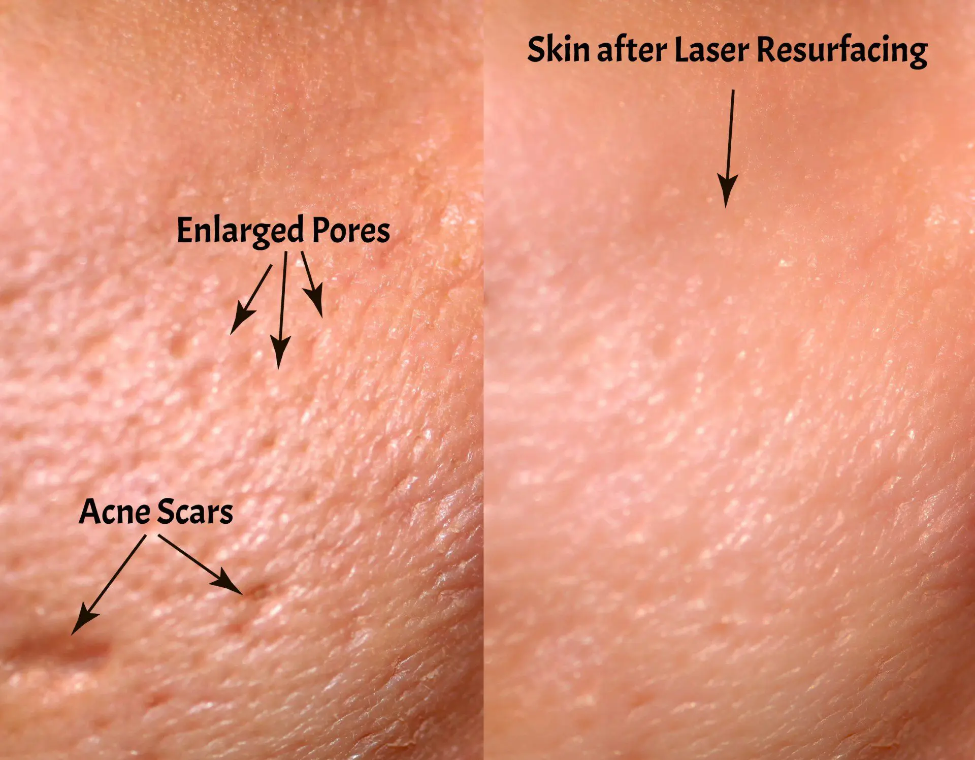 Comparison,Of,Skin,Before,And,After,Laser,Resurfacing.,Skin,With Acne scars treatment Charlotte, NC