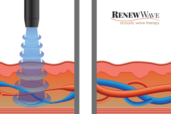 showing how shockwave heals blood vessels