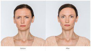 Botox and botox Alternatives for frown lines and skin wrinkles